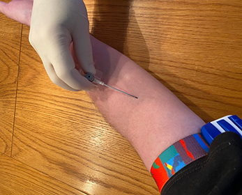 image of peripheral venous access cannulation