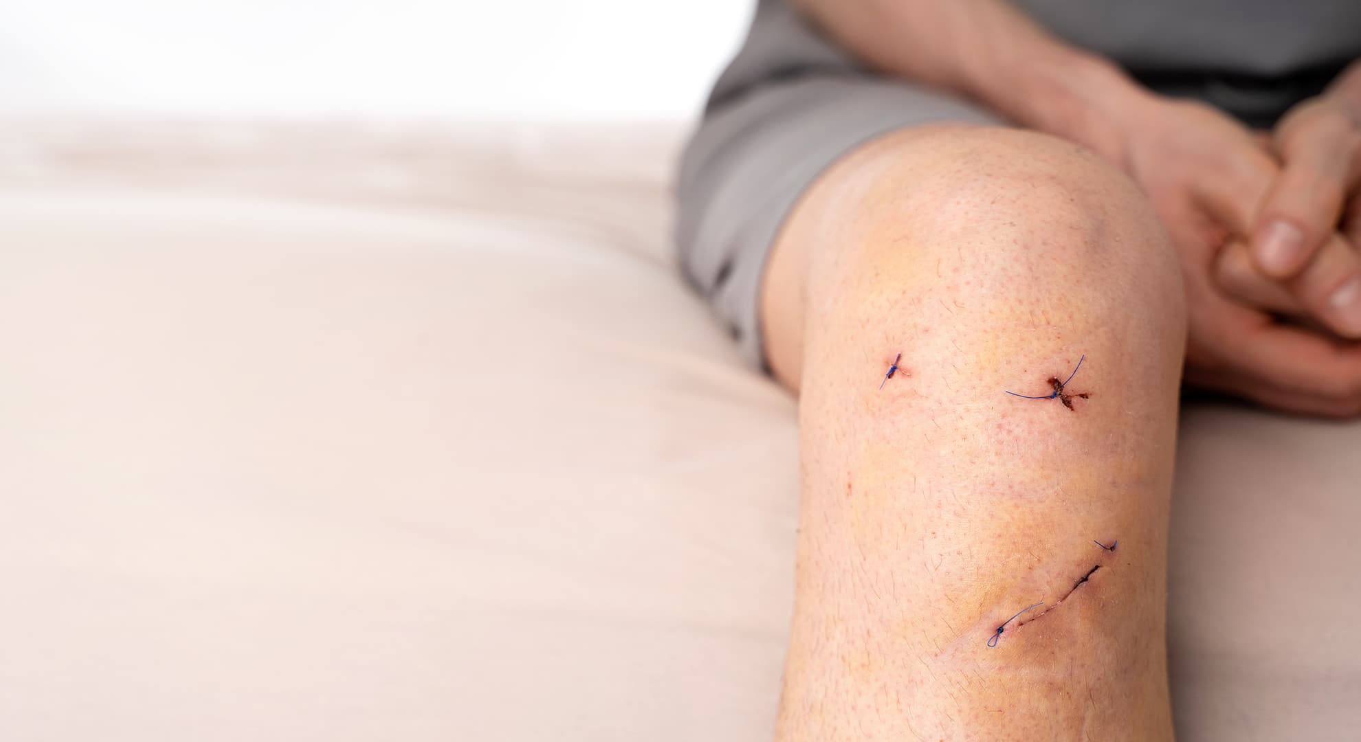 A knee with some surgery scars. 